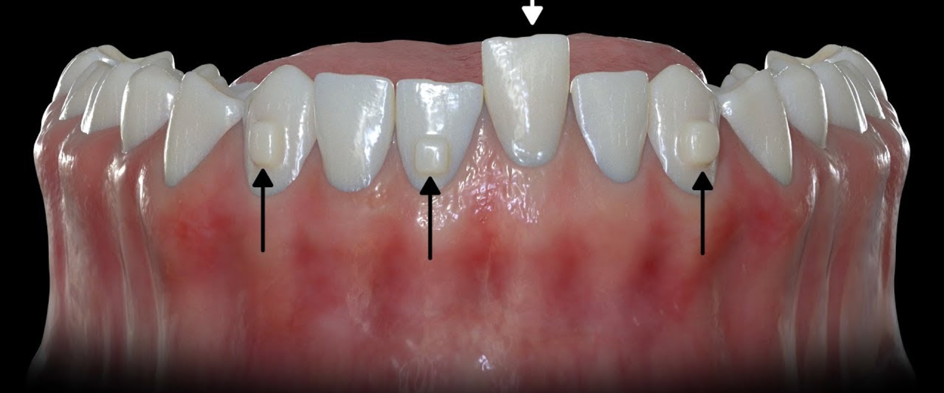 How Quickly Does Invisalign Move Teeth?