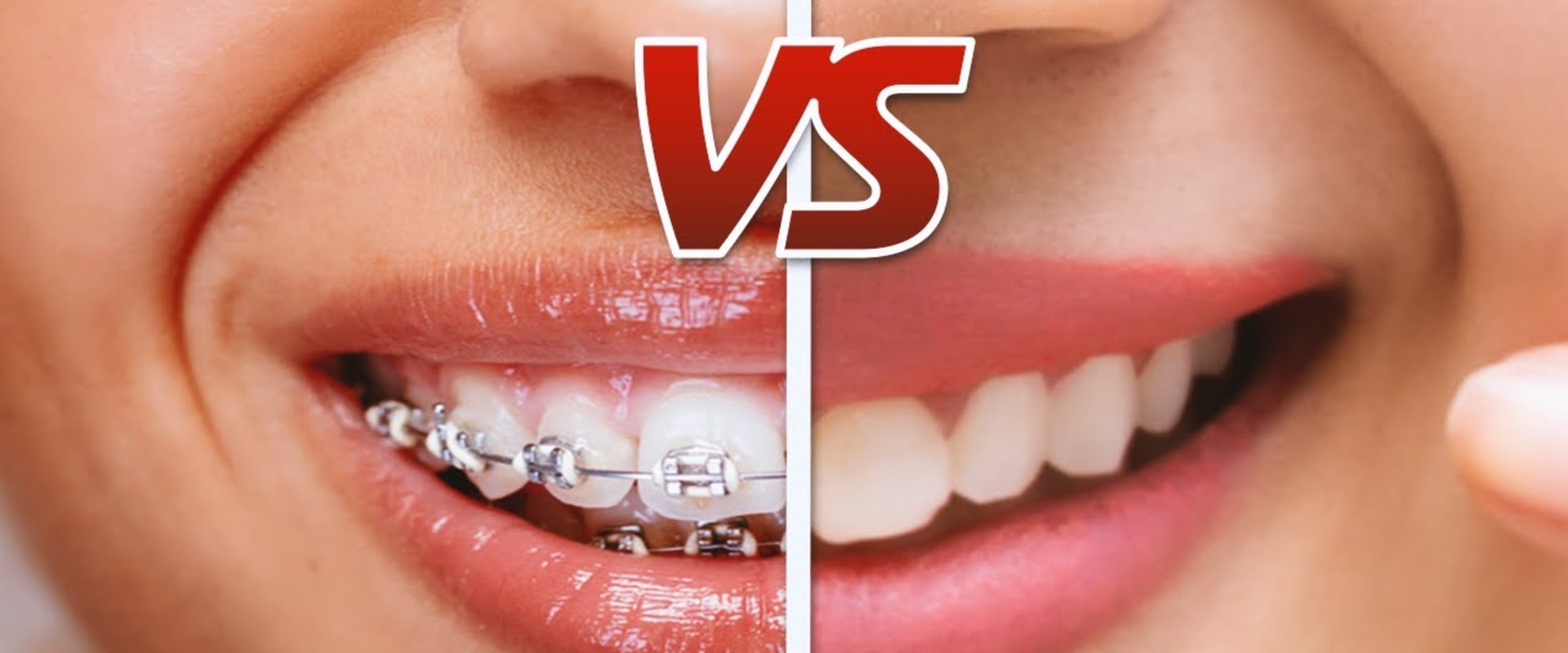 What is Cheaper Braces or Invisalign?