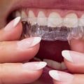 Why Braces are Better than Invisalign