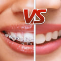 Is Invisalign a Better Option than Regular Braces?