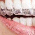 Is Invisalign Worth the Trouble? A Comprehensive Guide