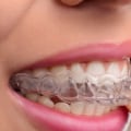 3 Foods and Drinks to Avoid When Wearing Invisalign Aligners