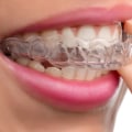 What's the Cheapest Way to Get Invisalign?