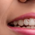 How Long Does Invisalign Hurt? Expert Advice on Pain Relief