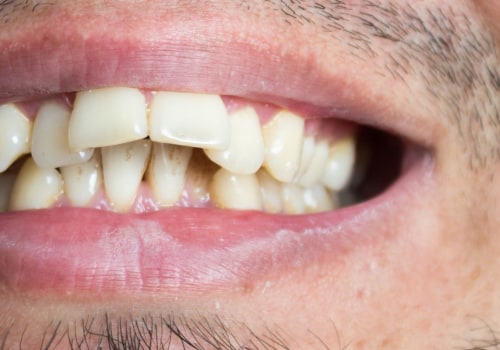 Straighten Your Teeth with Invisalign: What Types of Teeth Can Be Treated