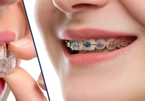 Braces vs Invisalign: Which is Better for Orthodontic Treatment?