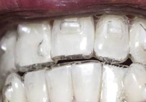 What Does Invisalign Do? A Comprehensive Guide