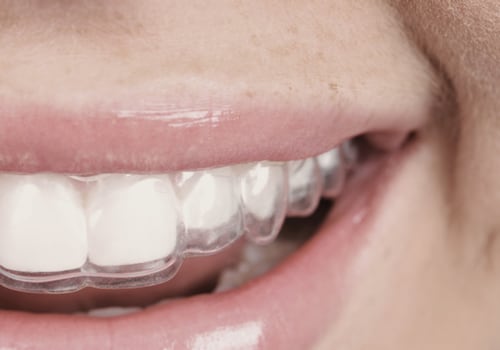 Do Teeth Relapse After Invisalign? An Expert's Perspective