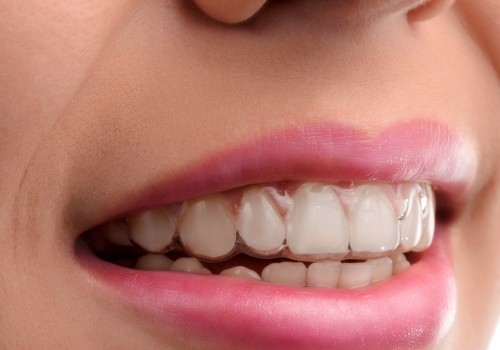 Does Invisalign Treatment Hurt? An Expert's Perspective