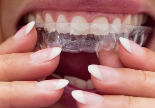 Why Braces are Better than Invisalign