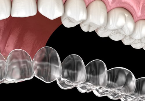 What is the Cheapest Cost for Invisalign Treatment?