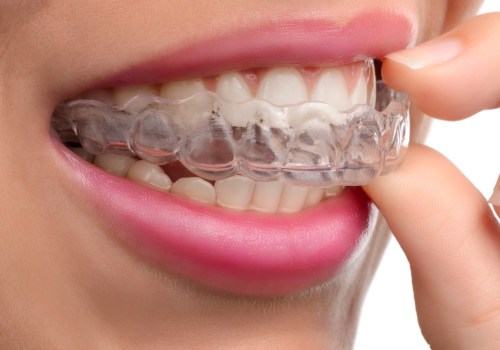 Qualifying for Invisalign: Is it Hard?