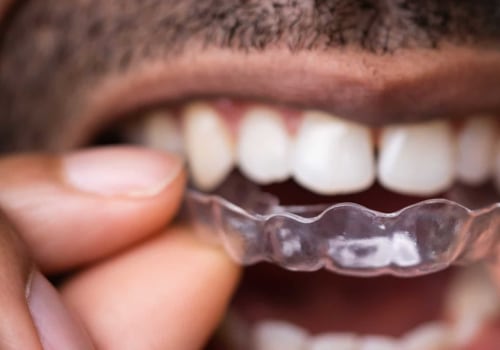 Are There Any Risks of Using Clear Aligners for Orthodontic Treatment?