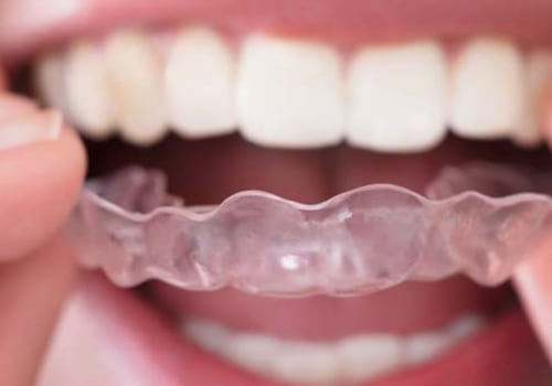 How Long Do Invisalign Results Last?