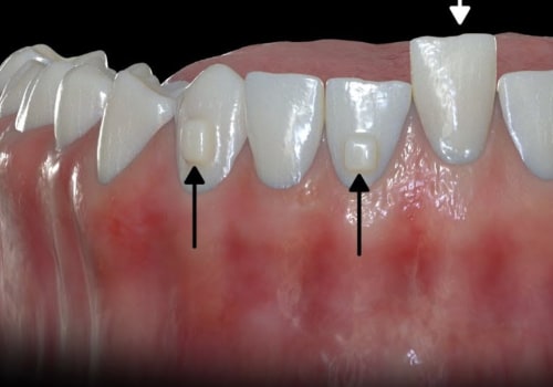 How Quickly Does Invisalign Move Teeth?