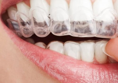 Can I Get Invisalign Treatment with Existing Dental Work?