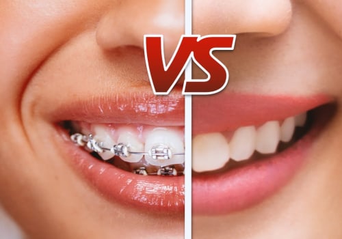 Invisalign vs Braces: What's the Difference and Which is Right for You?