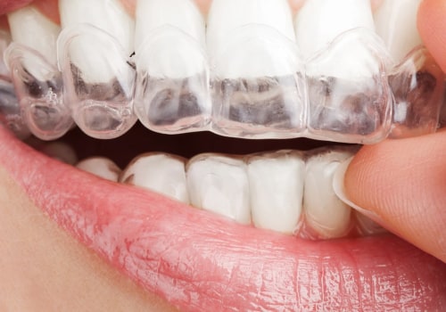 How Long Does Invisalign Last? An Expert's Guide