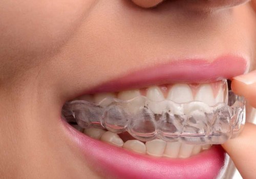 3 Foods and Drinks to Avoid When Wearing Invisalign Aligners