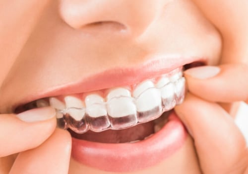 Do Your Teeth Move the First Week of Invisalign Treatment?