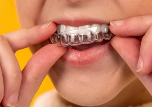 Can Invisalign Close a Missing Tooth Space?