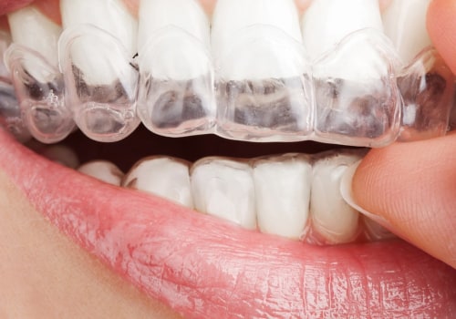 How Often Should I Change My Invisalign Aligners?