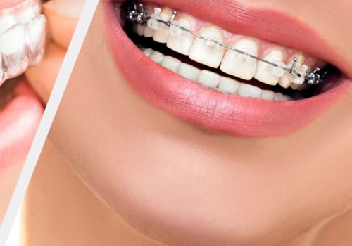 Invisalign vs Braces: Which is Faster for Results?