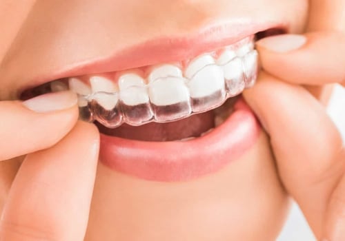 The Benefits of Invisalign: A Comprehensive Guide